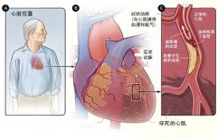 冠心病的起因是什么？