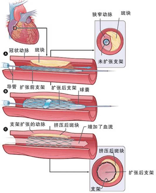 怎樣治療冠心??？(圖2)